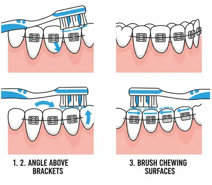 Can I use teeth whitening before braces
