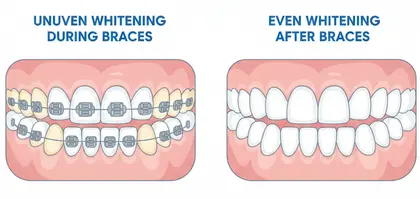 Teeth whitening after braces